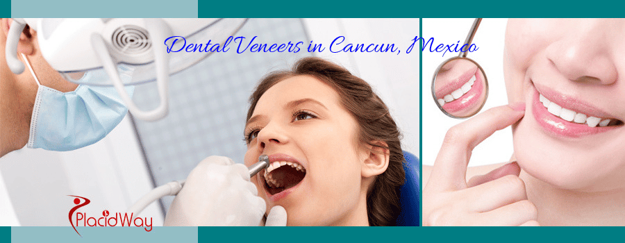 2500 veneers cancun